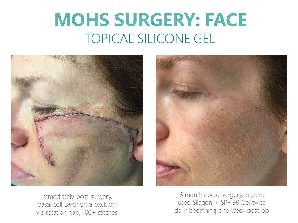 Silagen Scar Refinement 30 gm