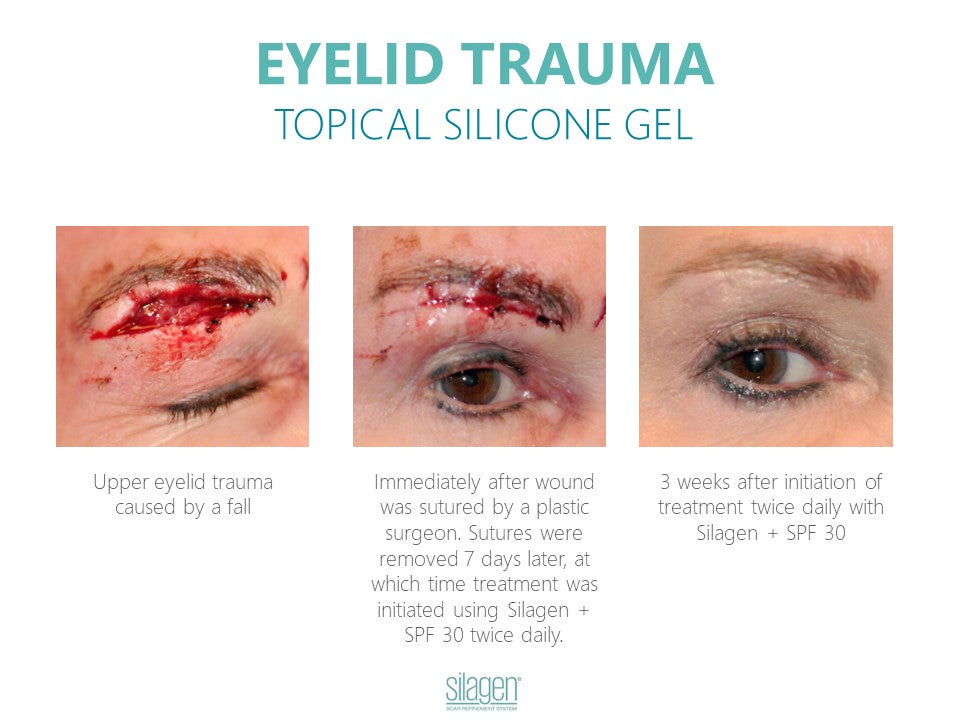 Silagen Scar Refinement 30 gm
