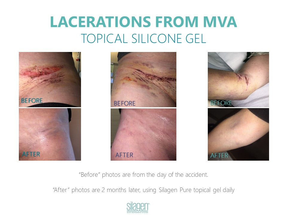 Silagen Scar Refinement 30 gm
