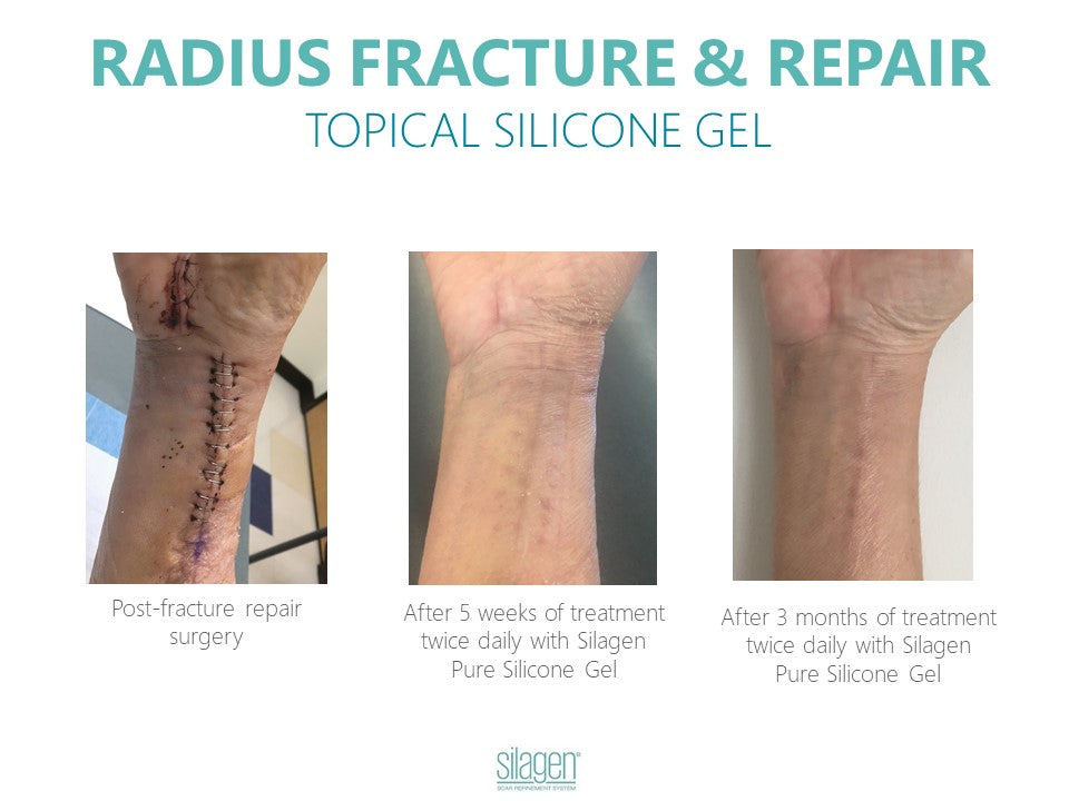 Silagen Scar Refinement 30 gm