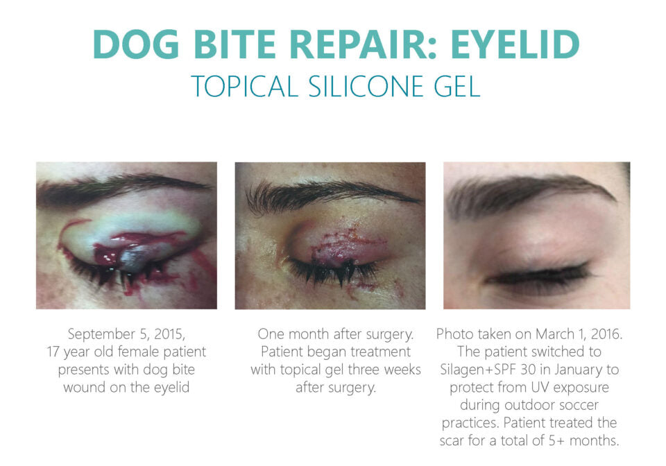 Silagen Scar Refinement 30 gm
