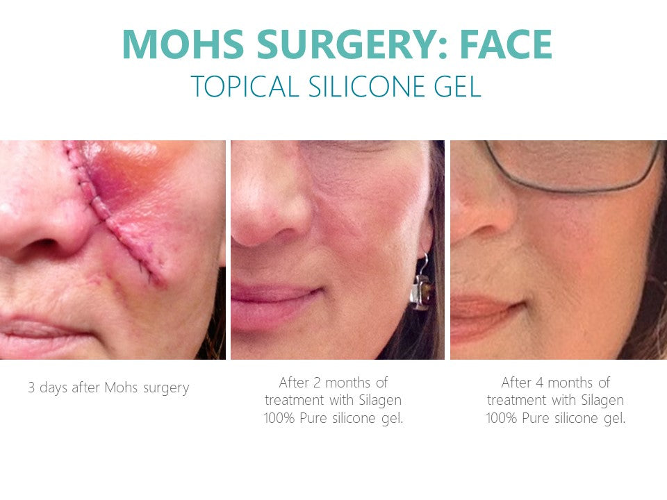 Silagen Scar Refinement 30 gm